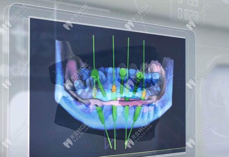 数字化allon4半口种植牙